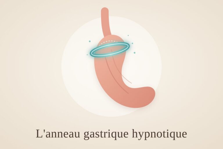 Anneau gastrique hypnotique : script, efficacité réelle et limites